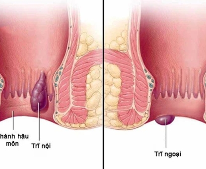 Bệnh trĩ có gây ung thư không?